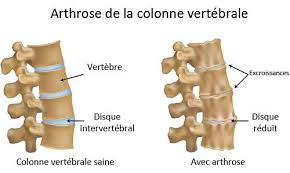 Arthrose colonne vertébrale