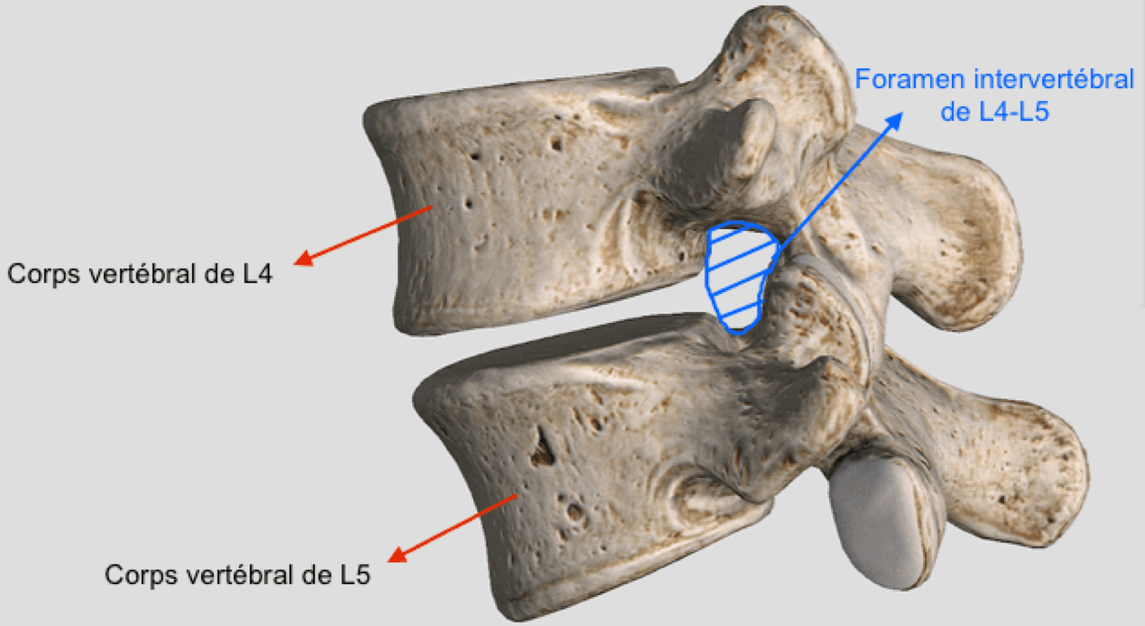 Difference Entre Bloc Foraminal Et Bloc Facettaire